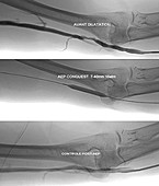 Treatment for blocked brachial vein, X-ray