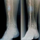 Treatment for blocked leg arteries, X-ray