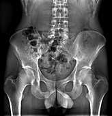 Male pelvis bones and joints, X-ray