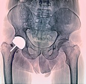 Hip joint resurfacing, X-ray