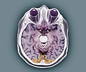 Human eyes and brain, MRI scan