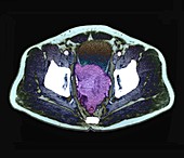 Prostate cancer, abdominal CT scan