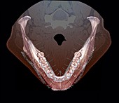 Lower jaw and teeth, 3D CT scan