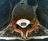 Thoracic vertebra and spinal cord, MRI scan