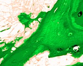 Giant cell osteosarcoma, fluorescence light micrograph