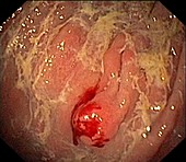 Carcinoid tumour, endoscope view