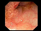 Colon cancer, endoscope view