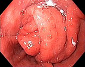 Gastro-oesophageal prolapse in hernia, endoscope view