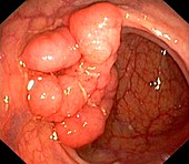 Colon cancer, endoscopic view
