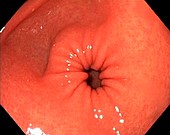 Healthy antrum of the stomach, endoscope view