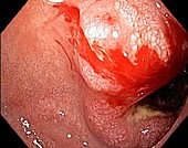 Pancreatic cancer, endoscope view