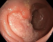 Solitary rectal ulcer syndrome, endoscope view