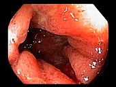 Ulcerative proctitis, endoscopic view