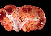 Kidney affected by myeloid leukaemia