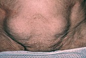 Bilateral inguinal hernia in a 75-year-old woman