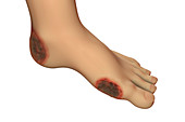 Diabetic foot ulcers, illustration