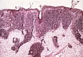 Mycosis fungoides, light micrograph