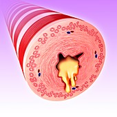 Bronchus with excess mucus, illustration
