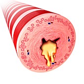 Bronchus with excess mucus, illustration