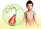 Child with gallstones, illustration