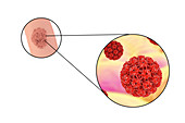 Penile warts and human papilloma virus, illustration