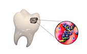 Tooth decay and bacteria, illustration