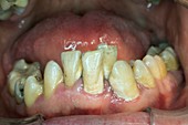 Crowded teeth covered with plaque and tartar