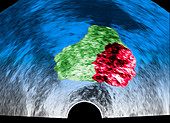 Cancer prostate, ultrasound scan