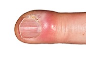 Paronychia infection of the finger