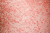 Amoxicillin rash in glandular fever
