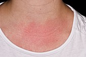 Allergic reaction to chest rub