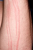 Dermatographic urticaria