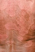 Ringworm rash