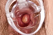 Benign vaginal polyp