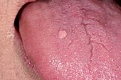 Tongue wart