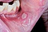 Mouth ulcer in anaemia