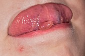 Oral mucocoele