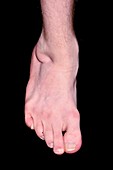 Club foot following surgery in childhood