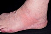 Swollen ankle in gout