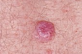 Basal cell carcinoma skin cancer