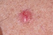 Basal cell carcinoma skin cancer