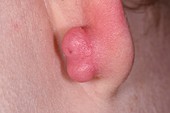Keloid scarring in infected ear piercing