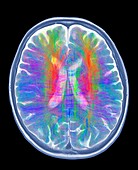 Brain MRI and white matter fibres