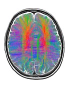 Brain MRI and white matter fibres