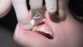 Fitting dental braces