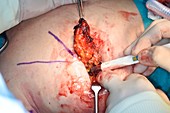 Tumour excision in breast cancer surgery