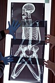 Peruvian mummy, X-ray research