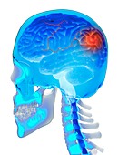 Brain haemorrhage, illustration