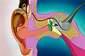 Cochlear implant, illustration