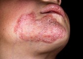 Tinea fungal face infection